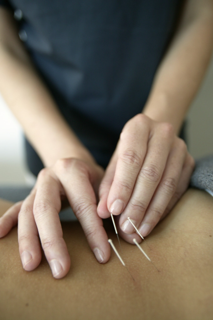Acupuncture